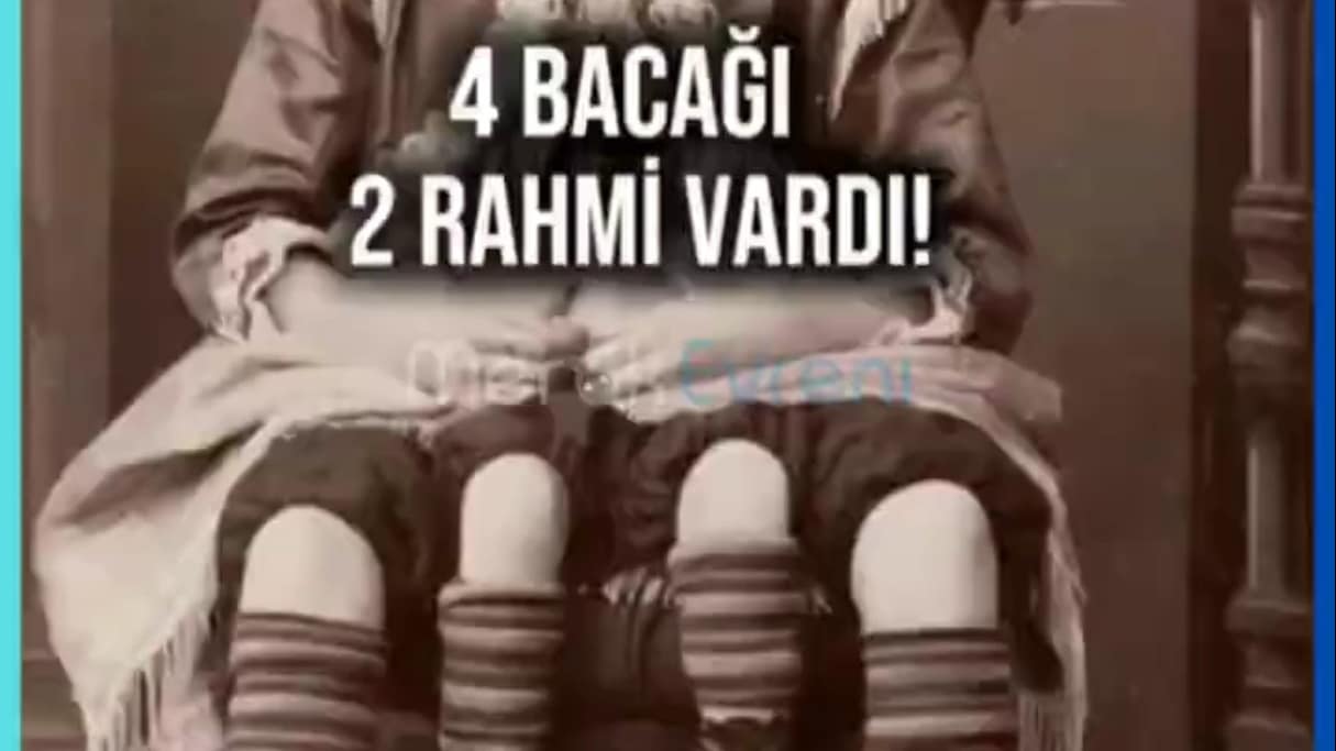4 Bacak ve 2 Rahimle Yaşamak: Myrtle Corbin