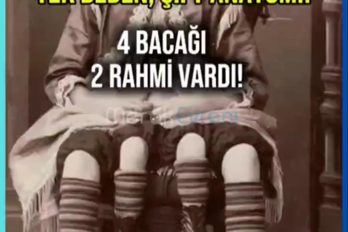 4 Bacak ve 2 Rahimle Yaşamak: Myrtle Corbin